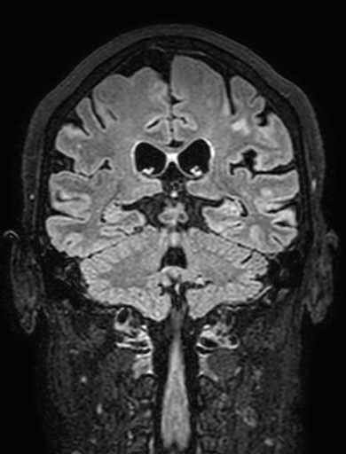 Cavernous hemangioma of the cerebellar falx (Radiopaedia 73025-83724 Coronal FLAIR 219).jpg