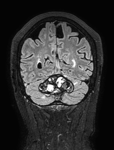 Cavernous hemangioma of the cerebellar falx (Radiopaedia 73025-83724 Coronal FLAIR 276).jpg