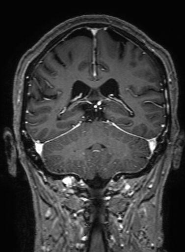 Cavernous hemangioma of the cerebellar falx (Radiopaedia 73025-83724 Coronal T1 C+ 249).jpg