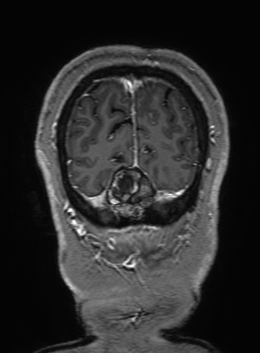 Cavernous hemangioma of the cerebellar falx (Radiopaedia 73025-83724 Coronal T1 C+ 338).jpg