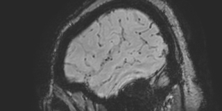 Cavernous hemangioma of the cerebellar falx (Radiopaedia 73025-83724 Sagittal BOLD 24).jpg