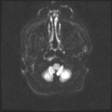 Cavernous sinus meningioma (Radiopaedia 63682-72367 DWI 43).jpg