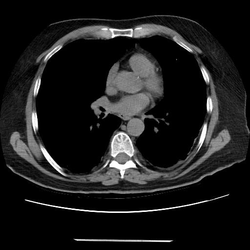 File:Cavitating pulmonary metastases (Radiopaedia 89545-106544 Axial non-contrast 32).jpg