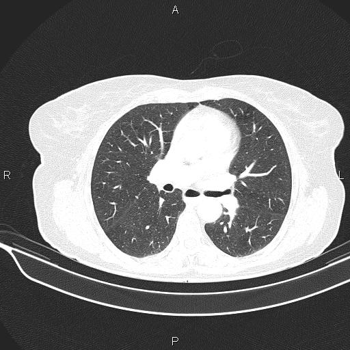 Cecal cancer (Radiopaedia 85610-101358 Axial lung window 31).jpg