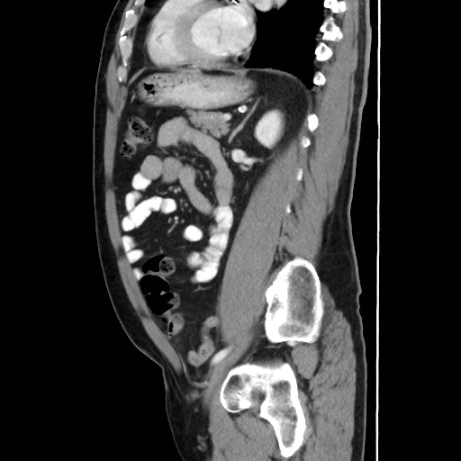 Cecal mass causing appendicitis (Radiopaedia 59207-66531 C 42).jpg