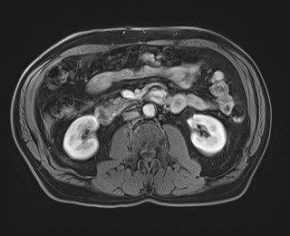 Cecal mass causing appendicitis (Radiopaedia 59207-66532 T1 C+ PV phase 67).jpg