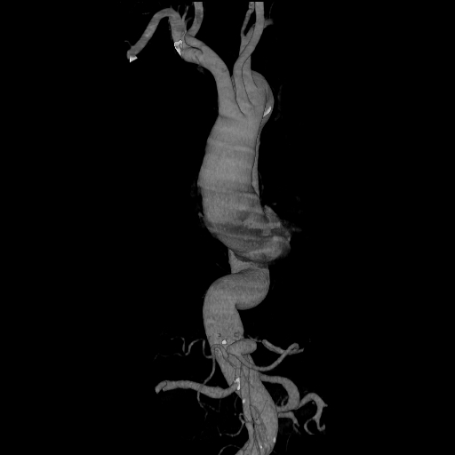 File:Celiac artery aneurysm (Radiopaedia 21574-21525 C 18).JPEG