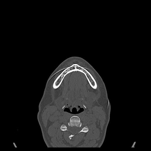 File:Cemento-ossifying fibroma (Radiopaedia 21243-21149 Axial bone window 14).jpg