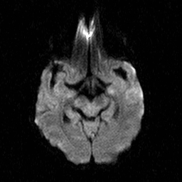 File:Central-variant posterior reversible encephalopathy syndrome (PRES) (Radiopaedia 43880-47358 Axial DWI 9).jpg