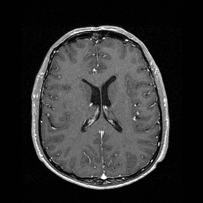 Central-variant posterior reversible encephalopathy syndrome (PRES) (Radiopaedia 43880-47358 Axial T1 C+ 99).jpg