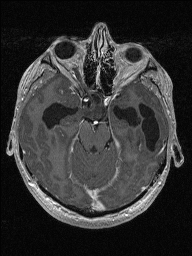 Central neurocytoma (Radiopaedia 56690-63469 Axial T1 C+ 55).jpg
