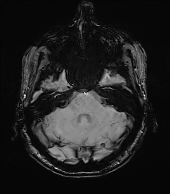 Central neurocytoma (Radiopaedia 71068-81303 Axial SWI 12).jpg