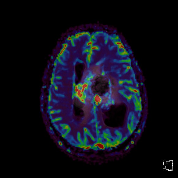 Central neurocytoma (Radiopaedia 84497-99872 Axial Perfusion 125).jpg