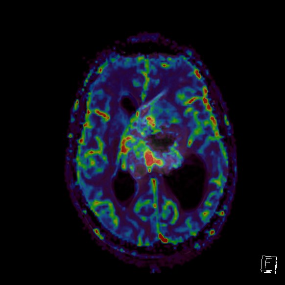 Central neurocytoma (Radiopaedia 84497-99872 Axial Perfusion 144).jpg