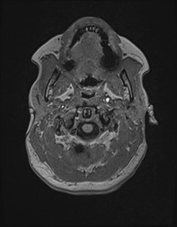 Central neurocytoma (Radiopaedia 84497-99872 Axial T1 21).jpg