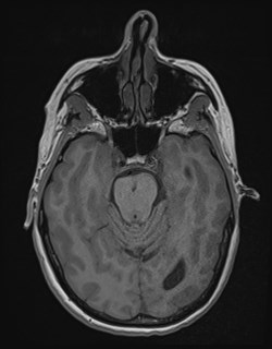 Central neurocytoma (Radiopaedia 84497-99872 Axial T1 71).jpg