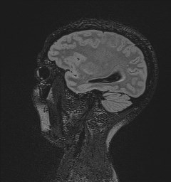 File:Central neurocytoma (Radiopaedia 84497-99872 Sagittal Flair + Gd 44).jpg