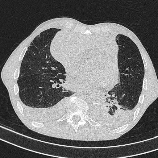 Central venous catheter tip extravasation (Radiopaedia 82828-97113 Axial lung window 54).jpg