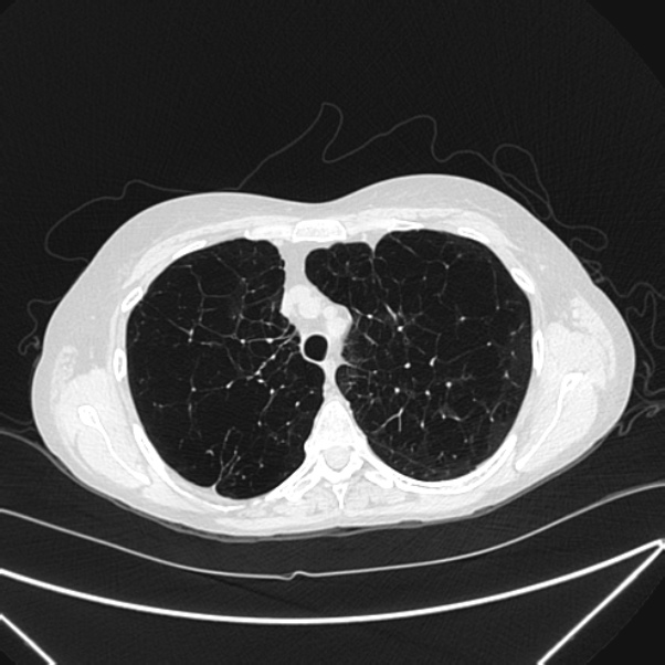 Centrilobular pulmonary emphysema (Radiopaedia 24495-24789 Axial lung window 26).jpg
