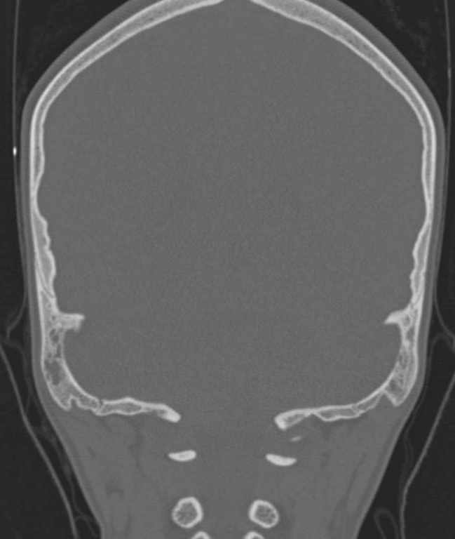 Cerebellar abscess (Radiopaedia 73727-84527 Coronal bone window 25).jpg