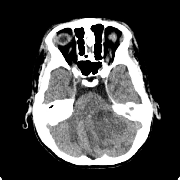 Cerebellar abscess secondary to mastoiditis (Radiopaedia 26284-26412 Axial non-contrast 41).jpg