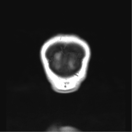 File:Cerebellar ependymoma complicated by post-operative subdural hematoma (Radiopaedia 83322-97736 Coronal T1 58).png