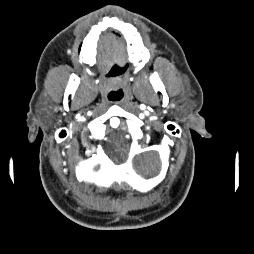 Cerebellar infarct due to vertebral artery dissection with posterior fossa decompression (Radiopaedia 82779-97029 C 51).png