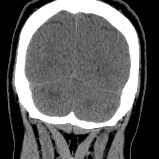 Cerebellar infarction (Radiopaedia 16625-16327 Coronal non-contrast 37).jpg