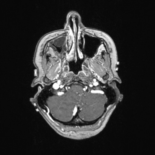 Cerebellar metastases (Radiopaedia 24038-24249 Axial T1 C+ 51).jpg