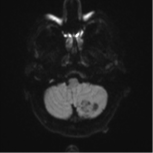 Cerebellar metastasis (Radiopaedia 51137-56765 Axial DWI 33).png