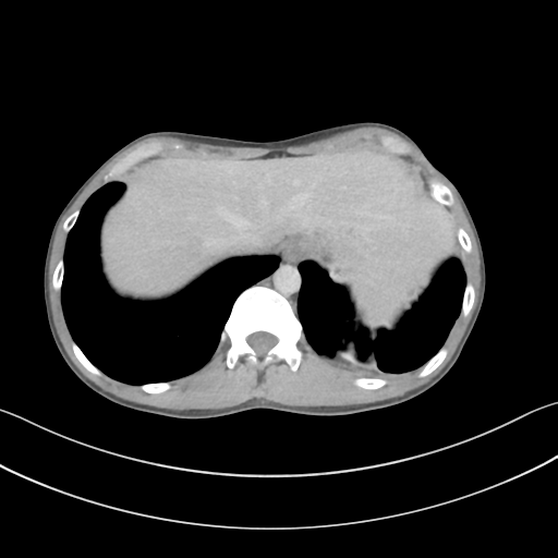 Cerebellar metastasis - adenocarcinoma lung (Radiopaedia 63184-71717 Axial C+ delayed 60).png