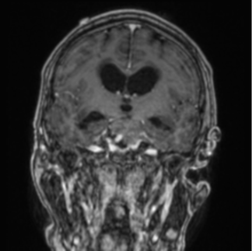 Cerebellar metastasis from lung adenocarcinoma (Radiopaedia 86690-102829 Coronal T1 C+ 54).png
