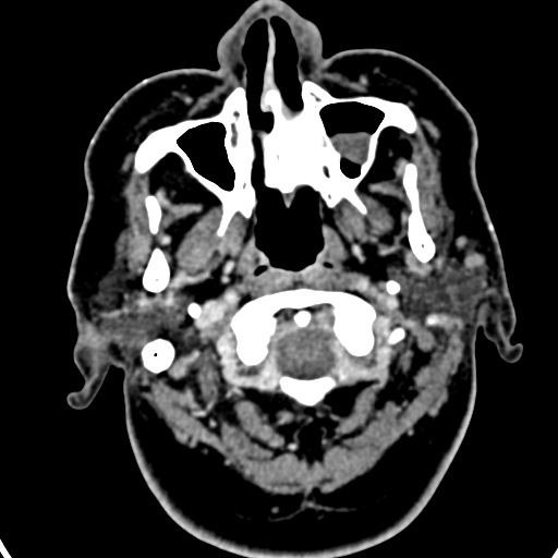 Cerebellopontine angle meningioma (Radiopaedia 35181-36714 A 63).jpg