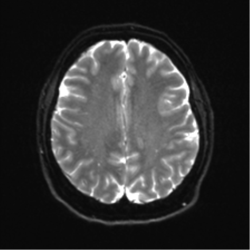 Cerebellopontine angle meningioma (Radiopaedia 48434-53348 Axial DWI 27).png