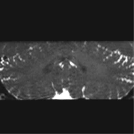File:Cerebellopontine angle meningioma (Radiopaedia 48434-53348 Coronal T2 21).png