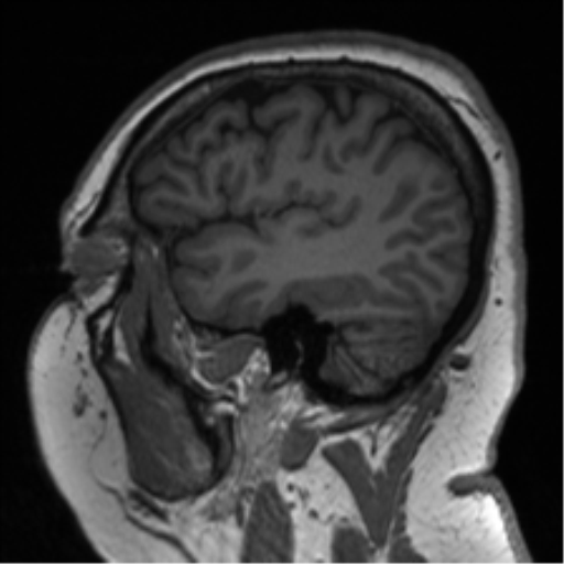 File:Cerebellopontine angle meningioma (Radiopaedia 48434-53348 Sagittal T1 23).png