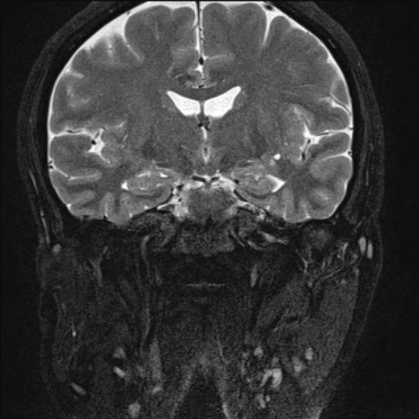 File:Cerebellopontine angle meningioma (Radiopaedia 53561-59591 Coronal T2 7).jpg