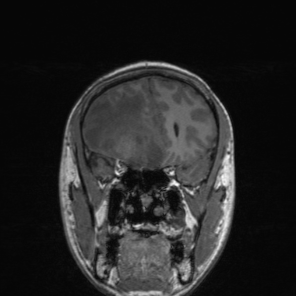 Cerebral abscess (Radiopaedia 24212-24478 Coronal T1 72).jpg