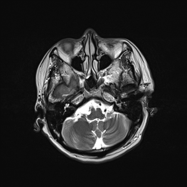Cerebral abscess (Radiopaedia 26111-26247 Axial T2 17).jpg