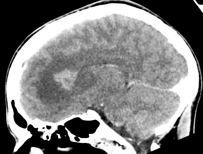 Cerebral abscess (Radiopaedia 60342-68008 Sagittal C+ delayed 28).png