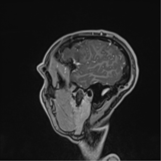 Cerebral abscess (Radiopaedia 60342-68009 J 48).png
