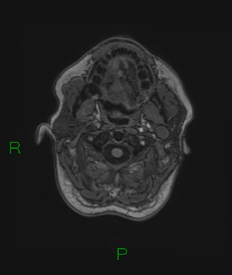 Cerebral abscess and subdural empyema (Radiopaedia 84436-99779 Axial T1 84).jpg