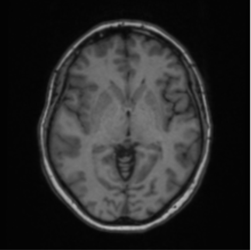 File:Cerebral abscess from pulmonary arteriovenous malformation (Radiopaedia 86275-102291 Axial T1 37).png