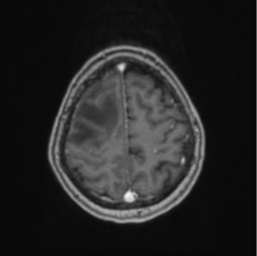 Cerebral abscess from pulmonary arteriovenous malformation (Radiopaedia 86275-102291 Axial T1 C+ 61).png