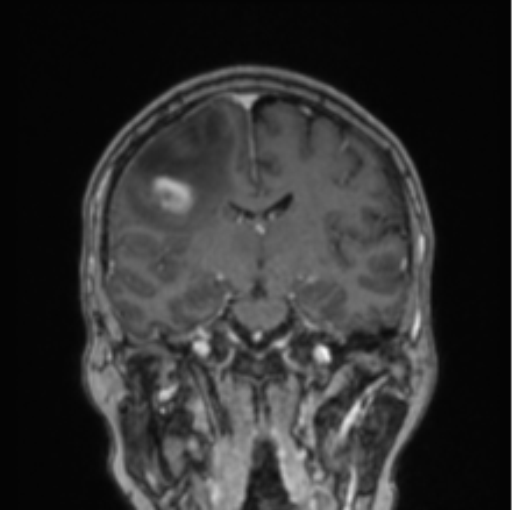 Cerebral abscess from pulmonary arteriovenous malformation (Radiopaedia 86275-102291 L 47).png