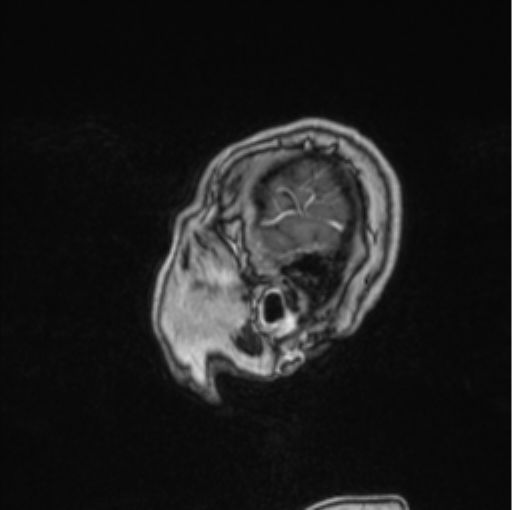 Cerebral abscess from pulmonary arteriovenous malformation (Radiopaedia 86275-102291 Sagittal T1 C+ 8).png
