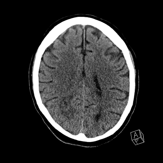 Cerebral abscess with ventriculitis (Radiopaedia 78965-91876 Axial non-contrast 32).jpg