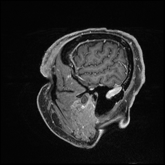 Cerebral abscess with ventriculitis (Radiopaedia 78965-91878 Sagittal T1 C+ 29).jpg