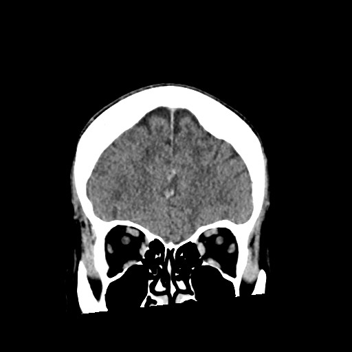 Cerebral amyloid angiopathy-related inflammation (Radiopaedia 74836-85848 Coronal non-contrast 18).jpg