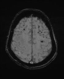 File:Cerebral amyloid angiopathy-related inflammation (Radiopaedia 74836-85849 Axial SWI 55).jpg